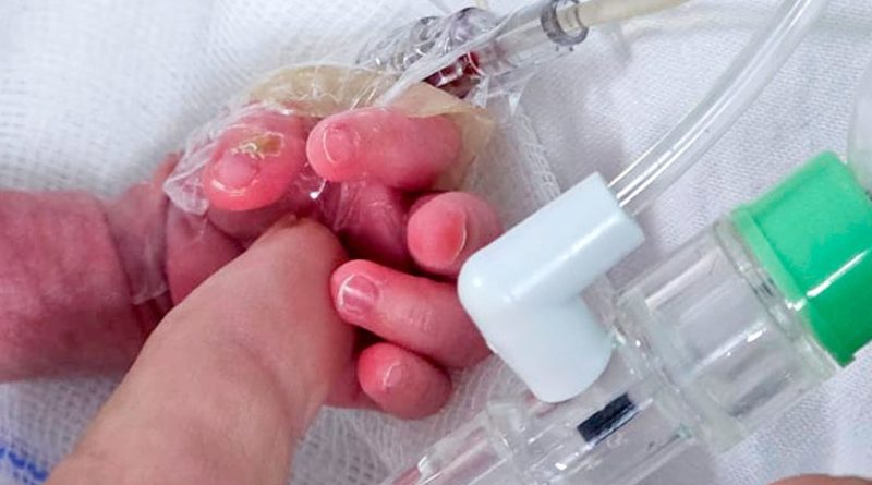 operaron exitosamente del corazón a un bebé prematuro